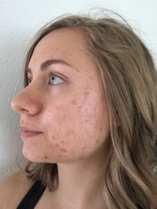 Mikaela Lauren Wellness Skin Journey Acne 2017